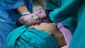 تفسير الولادة القيصرية في المنام لابن سيرين