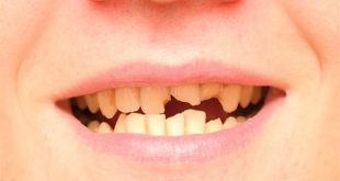 تفسير تكسر الأسنان في المنام لابن سيرين