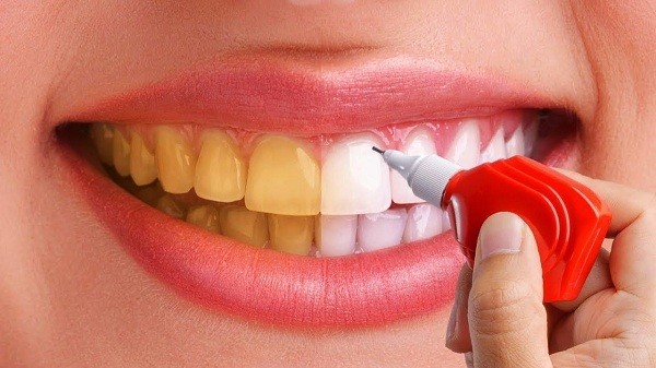 أنواع تبييض الأسنان وأسعارها
