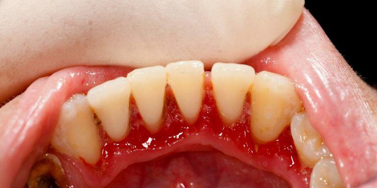 ما علاج نزيف اللثة عند تنظيف الأسنان؟