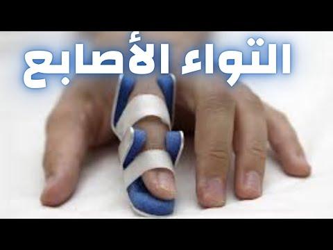 التواء الأصابع علاج تمزق اصبع اليد كيفية علاج جزع الاصبع دكتور احمد حسن جمعه 