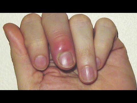 وصفة مجربة ومضمونة لعلاج الأصبع المدوحس بدون أدوية 
