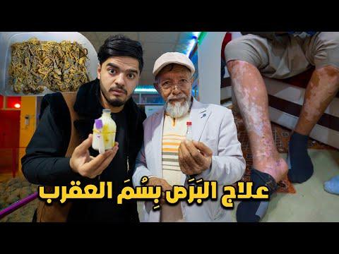 أخطر علاج بـ سم العقرب القاتل في افغانستان Treatment With Scorpion In Afghanistan 