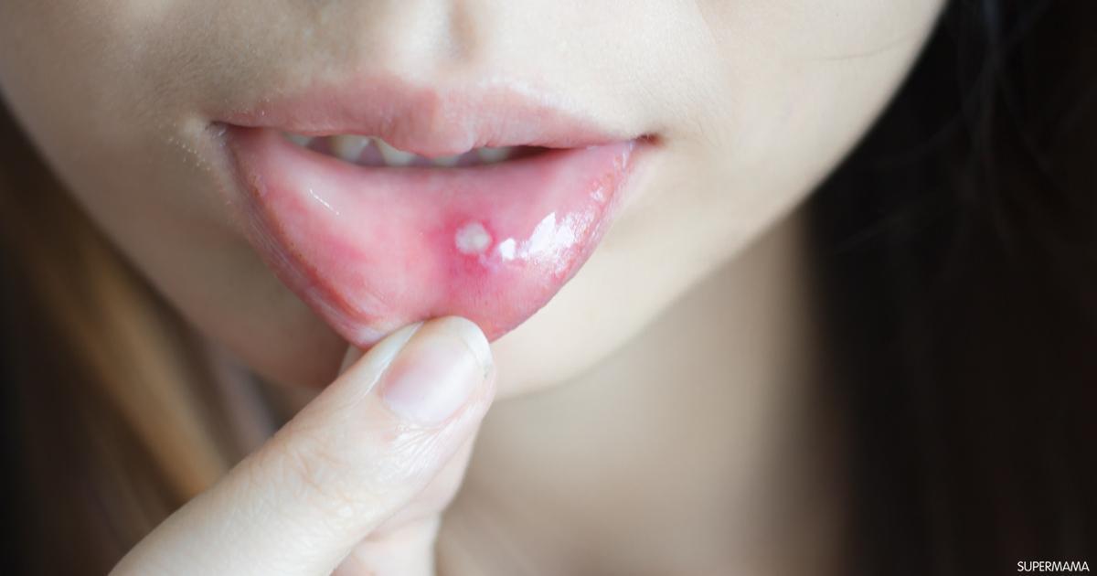 ما هي أنواع قرحة الفم واللسان ؟
