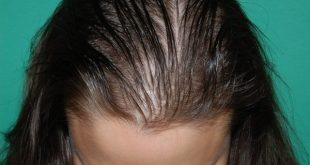 علاج تساقط الشعر الشديد عند النساء بالاعشاب
