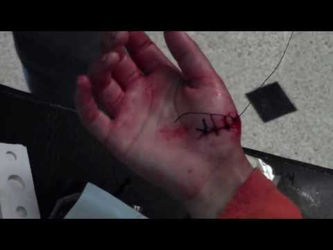 يوميات المشفى الميداني بسرمين خياط احد الجروح لاحد المصابين 11 7 2013 
