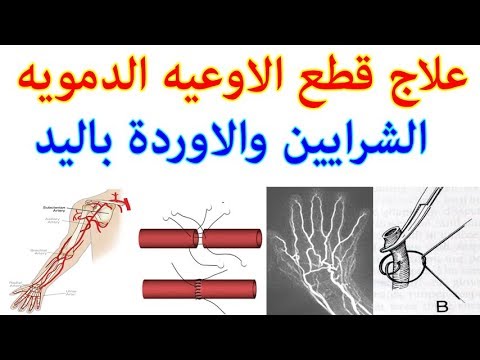 كيفية علاج قطع الاورده او الشرايين في اليد 