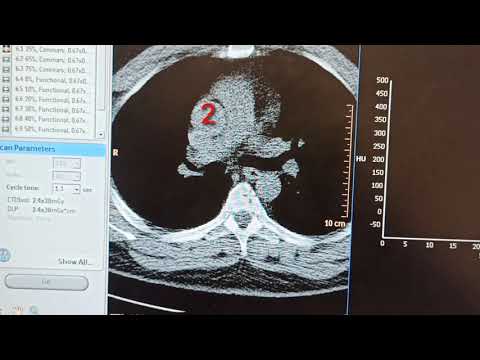 CT Coronary أشعة مقطعية علي شرايين القلب Cardic Angio Graphy 