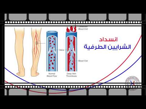 انسداد الشرايين في القدم 