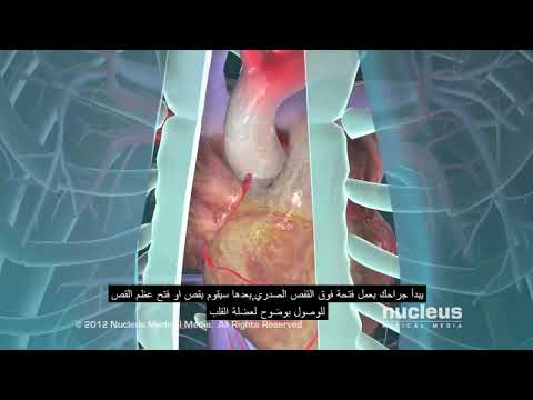 طعم مجازة الشريان التاجي (CABG). 