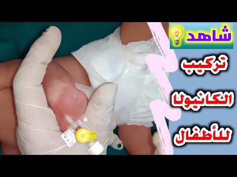 تركيب كانيولا لطفل لسه مولود رهيب رهيب Iv Cannula For A Newborn Baby MohamedKaneer 