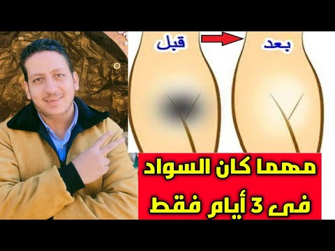 تفتيح المنطقة الحساسة في 3 أيام فقط اسرع مبيض للجسم مهما كان السواد 