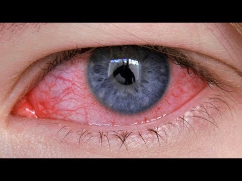 علاج إلتهاب العين طبيعيا والتخلص من إحمرار العين في المنزل بدقائق 