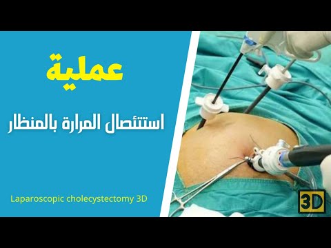 استئصال المرارة بالمنظار ثلاثي الأبعاد 