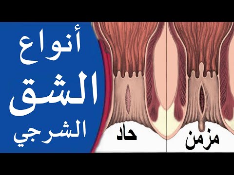 أنواع الشقوق الشرجية وعلاج أعراض وأسباب الجروح في الشرج والفرق بين الشقوق الحادة والمزمنة 